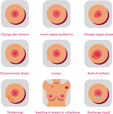 Thickening or swelling of part of the breast