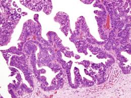 Adenocarcinoma