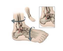 Ankle Injuries