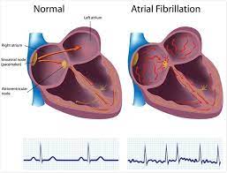 Fibrillation he