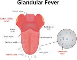 glandular fever