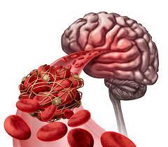 Ischemic strokes