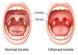 Tonsillitis