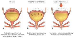 Urinary incontinence