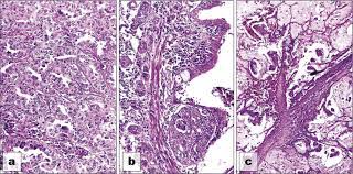 Adenocarcinoma