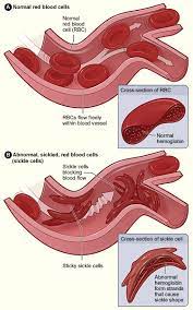 Blood disorders