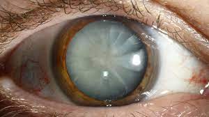 Cataract & IOL