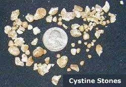 Cystine stones