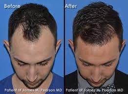 Hair replacement surgery