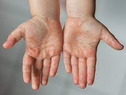 Hand foot and mouth disease