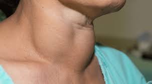 Hypothyroidism