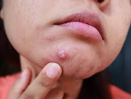 Pustules (small red bumps containing white or yell