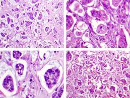 Adenocarcinoma