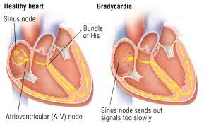 bradycardia heartbeat