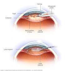 Cataracts Surgery