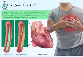 chest pain or discomfort