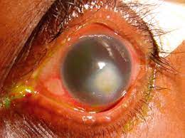 Corneal Blindness