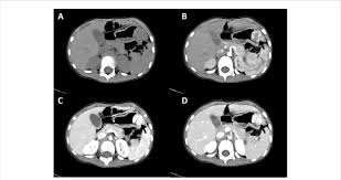 CT (computed tomography) scans