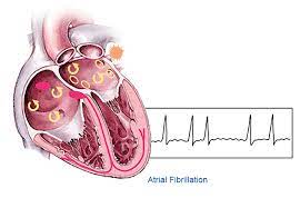 Fibrillation