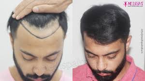 Hair replacement surgery