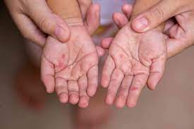 Hand foot and mouth disease