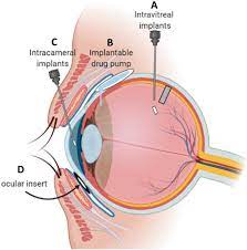 Intracameral