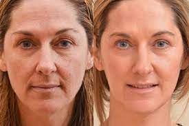 Laser skin resurfacing