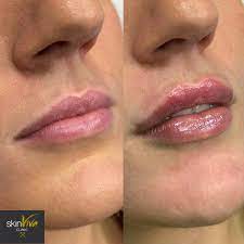 Lip augmentation