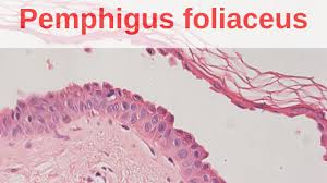 pemphigus foliaceus