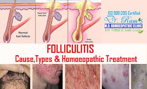 pityrosporum folliculitis