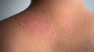 Raw, sensitive skin from scratching