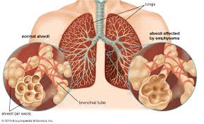 Respiratory Dysfunction