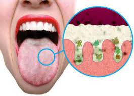 tongue halitosis bad breath