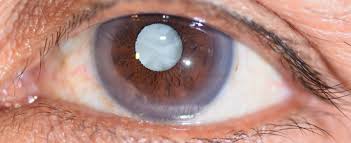 Cataract & IOL