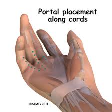 Dupuytrens Contracture Surgery