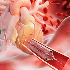 Endovascular Surgery