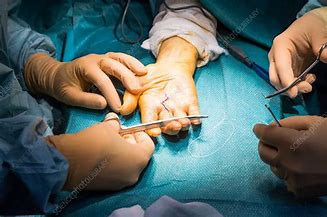 Hand Surgery