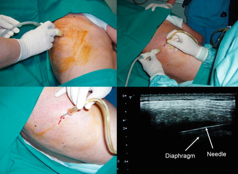 Interventional Radiology (ir)