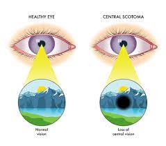 Paracentral Scotoma