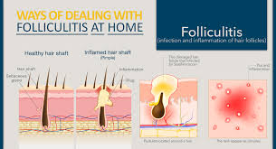 pityrosporum folliculitis