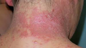 Redness around the skin eruptions